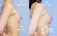 北京八大处郭时伟自体脂肪隆胸案例