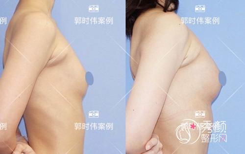 北京八大处郭时伟自体脂肪隆胸案例