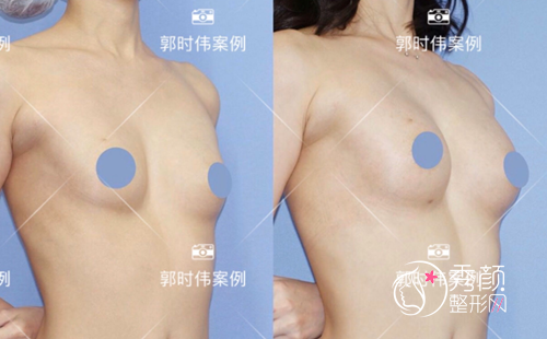 北京八大处郭时伟自体脂肪隆胸案例