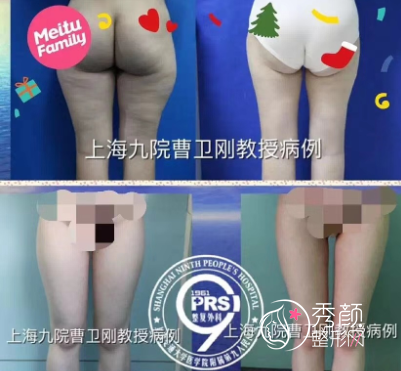 上海九院曹卫刚抽脂怎么样