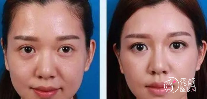 上海吴佳君医生拉皮怎么样,果好不好