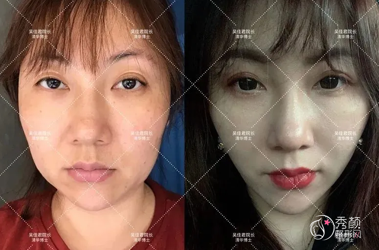 终于在上海做了小拉皮，术后5个月整个人年轻了10岁！