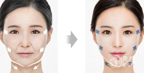 柳民熙和穆宝安哪个拉皮手术、面部提升除皱做的更好？