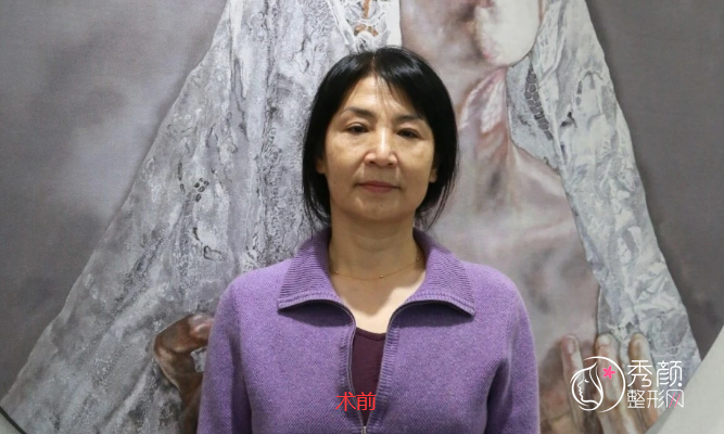 北京加减美黄寅守面部提升怎么样，案例有吗