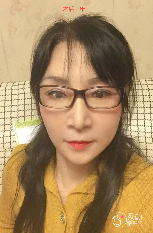 北京加减美黄寅守面部提升怎么样，案例有吗