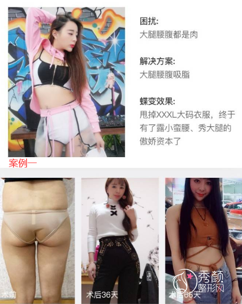 南京华美刘学新吸脂怎么样,有没有失败案例