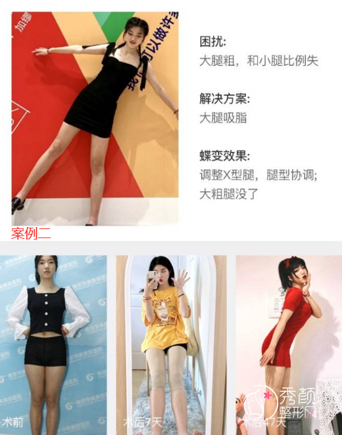 南京华美刘学新吸脂怎么样,有没有失败案例