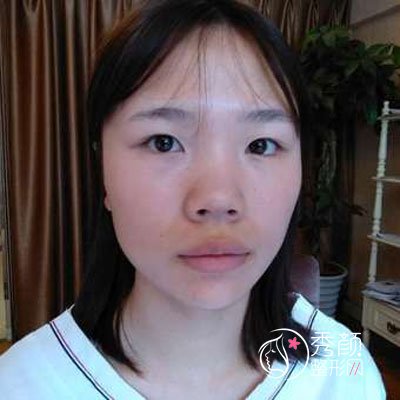 北京沃尔赵丹隆鼻怎么样，有没有失败案例