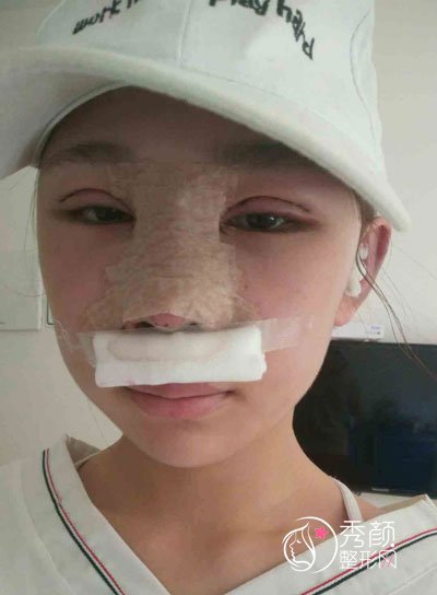 北京沃尔赵丹隆鼻怎么样，有没有失败案例