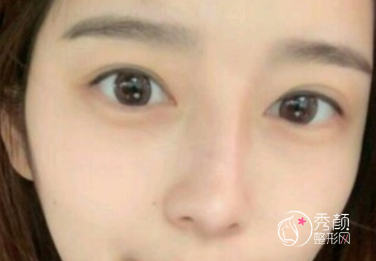 上海柴云做双眼皮修复怎么样，有没有失败案例