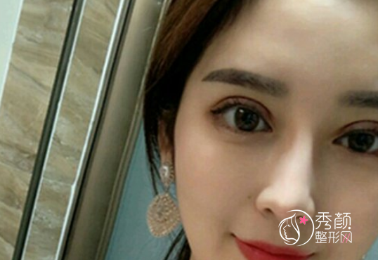 上海柴云做双眼皮修复怎么样，有没有失败案例