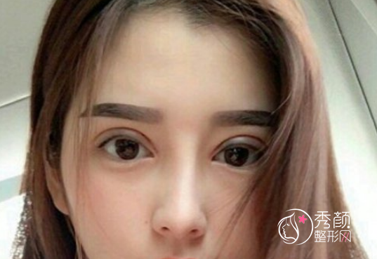 上海柴云做双眼皮修复怎么样，有没有失败案例