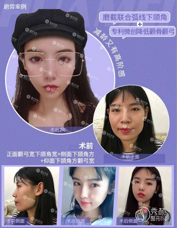 重庆华美潘宝华磨骨怎么样,有没有失败案例?