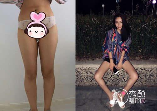 上海爱莫儿孙长辉吸脂怎么样,有没有失败案例?