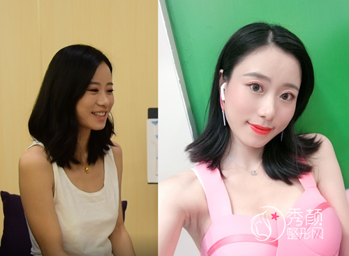 广州华美郝永生隆胸怎么样,大概需要多少钱?