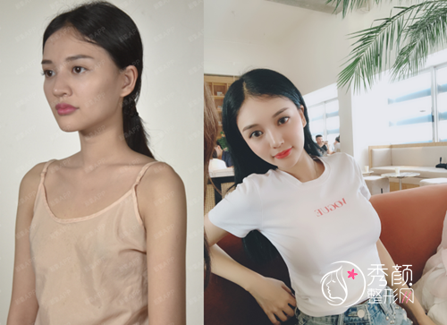 广州隆胸哪个医生好,冯传波和郝永生隆胸怎么样？