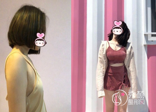 广州隆胸哪个医生好,冯传波和郝永生隆胸怎么样？