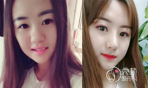 北京画美徐学东隆鼻怎么样，有没有失败案例？