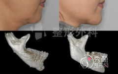 <b>下颌骨矫正要多少钱？下巴后缩怎么矫正,有哪些方法？</b>