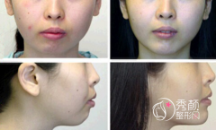 <b>下颌骨不对称矫正大概需要多少钱?</b>