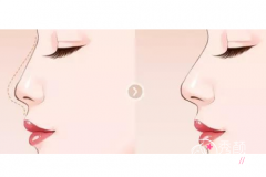 北京八大处哪个医生做鼻子技术好,果自然