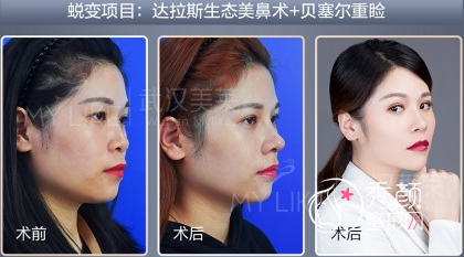 武汉美莱单喆隆鼻|鼻修复怎么样,有没有失败案例?