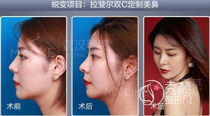 武汉美莱单喆隆鼻|鼻修复怎么样,有没有失败案例?