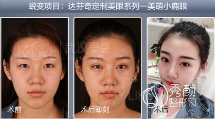 武汉美莱单喆隆鼻|鼻修复怎么样,有没有失败案例?