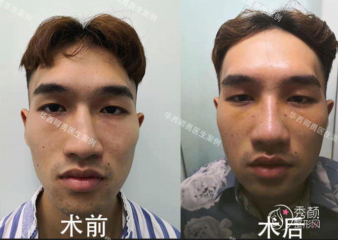 四川华西医院卿勇隆鼻怎么样,有没有失败案例?