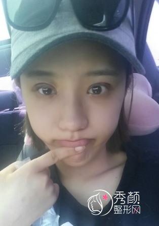 上海伊莱美桂鹏做双眼皮怎么样,有没有失败案例?