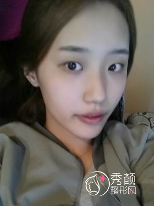 上海伊莱美桂鹏做双眼皮怎么样,有没有失败案例?