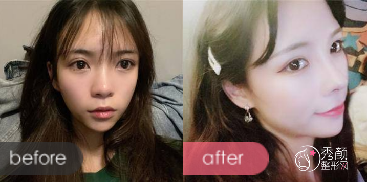 重庆军美章小平隆鼻怎么样，有没有失败案例？