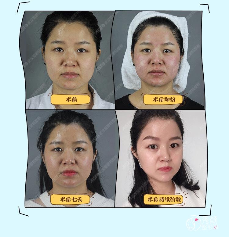 武汉爱思特袁伟院长吸脂怎么样,有没有失败案例？