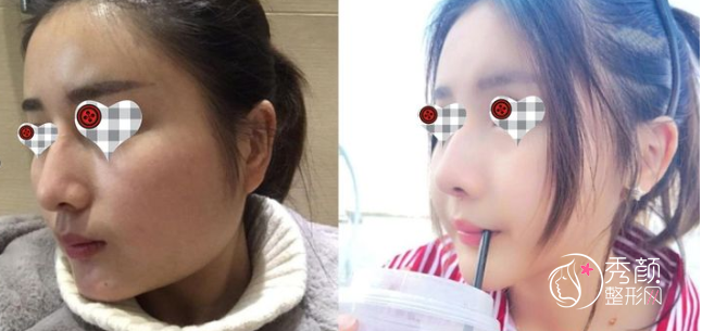 南京友谊整形金柱翰磨骨怎么样，有失败案例吗？