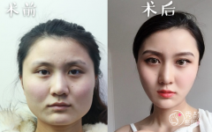 北京何照华和黄大勇磨骨哪个好