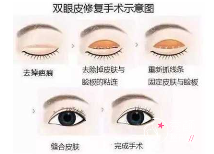 国内双眼皮修复陈芝、高寿松、潘贰、韩勋、刘学源哪个医生好