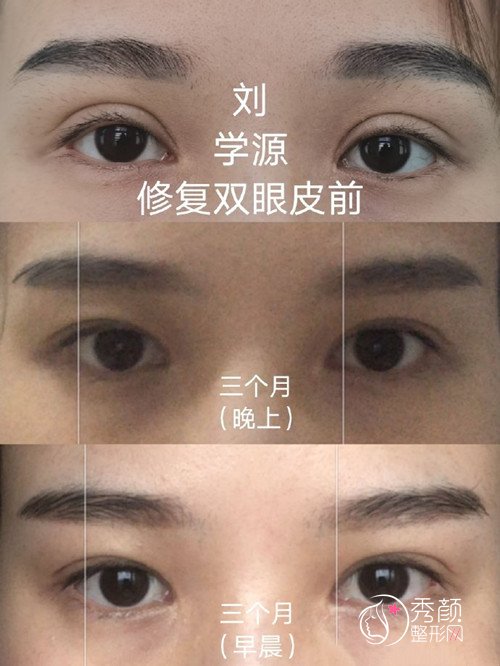 青岛刘大夫医学美容刘学源双眼皮修复好吗？