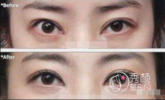 青岛哪个医生修复双眼皮比较好|医院医生技术审美测评