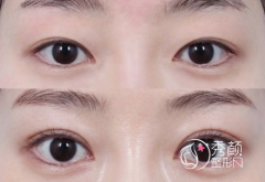 郑州双眼皮修复田国静和杨丽哪个好