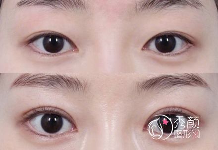 郑州双眼皮修复田国静和杨丽哪个好