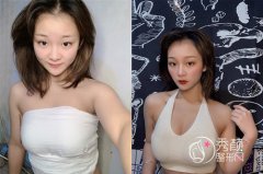 广州隆胸美恩许扬滨和华美郝永生哪个技术更好