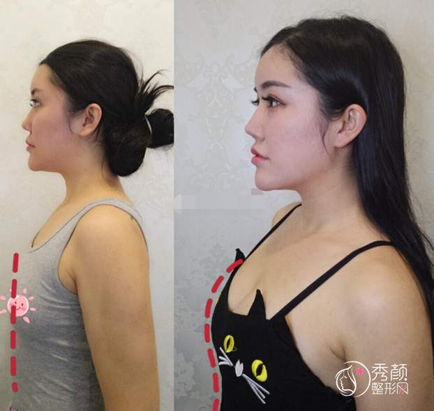 广州隆胸美恩许扬滨和华美郝永生哪个技术更好