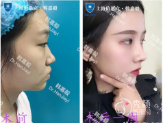 <b>上海伯思立韩嘉毅隆鼻修复好吗，有失败案例吗</b>