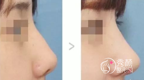 北京八大处隆鼻哪个医生好,王欢、尤建军还是刘暾?