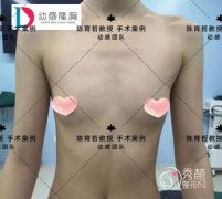 北京陈育哲动感隆胸案例