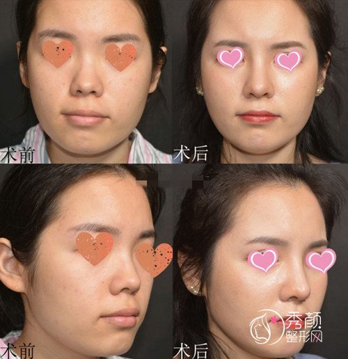 北京画美徐学东隆鼻怎么样,有没有失败案例?