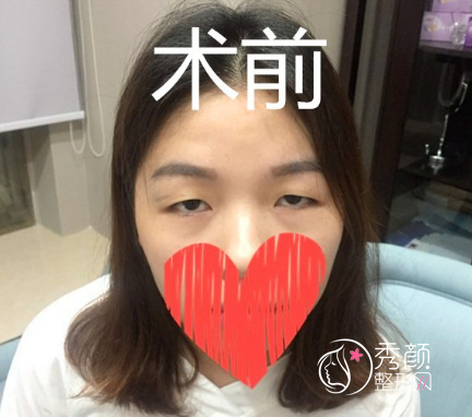 成都西区车红昌做双眼皮修复怎么样，大概需要多少钱？