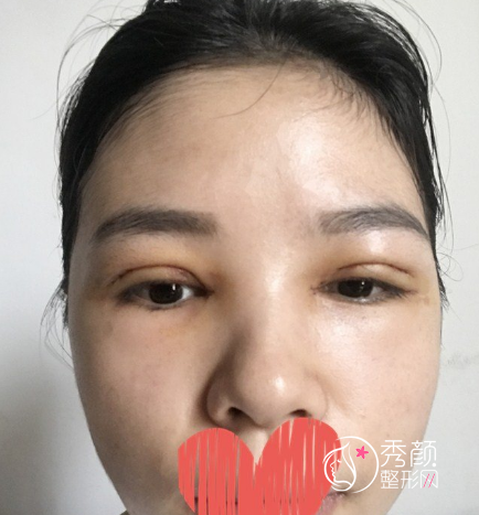 成都西区车红昌做双眼皮修复怎么样，大概需要多少钱？