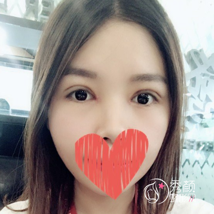 成都西区车红昌做双眼皮修复怎么样，大概需要多少钱？