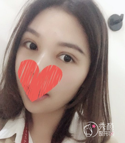 成都西区车红昌做双眼皮修复怎么样，大概需要多少钱？